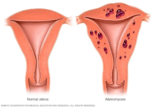 Adenomyosis - Its Impact On Fertility