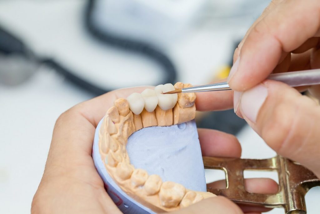 Factors Affecting Dental Bridge Cost